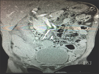 Click here to view Large Figure 1 biomedres-openaccess-journal-bjstr
