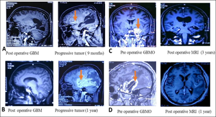 Click here to view Large Figure 1 biomedres-openaccess-journal-bjstr