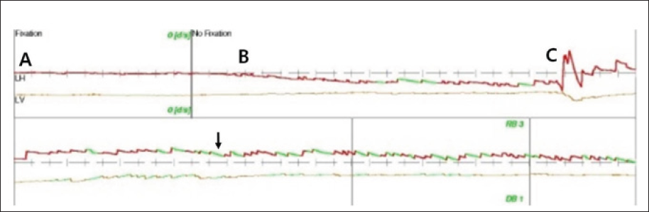 Click here to view Large Figure 1 biomedres-openaccess-journal-bjstr