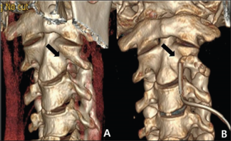 Click here to view Large Figure 1 biomedres-openaccess-journal-bjstr