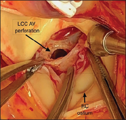 Click here to view Large Figure 1 biomedres-openaccess-journal-bjstr