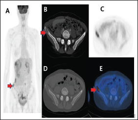 Click here to view Large Figure 1 biomedres-openaccess-journal-bjstr