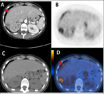 Click here to view Large Figure 1 biomedres-openaccess-journal-bjstr