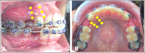 Click here to view Large Figure 1 biomedres-openaccess-journal-bjstr