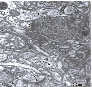 Click here to view Large Figure 1 biomedres-openaccess-journal-bjstr