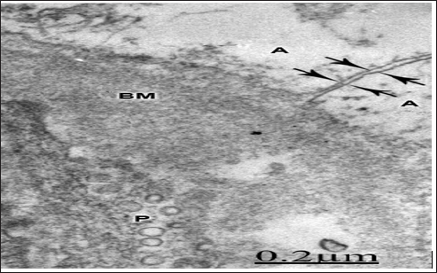 Click here to view Large Figure 1 biomedres-openaccess-journal-bjstr