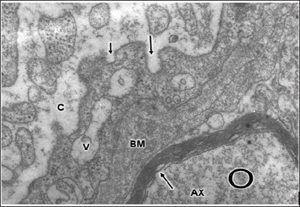 Click here to view Large Figure 1 biomedres-openaccess-journal-bjstr