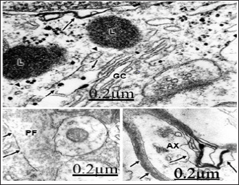 Click here to view Large Figure 1 biomedres-openaccess-journal-bjstr