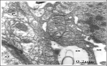 Click here to view Large Figure 1 biomedres-openaccess-journal-bjstr