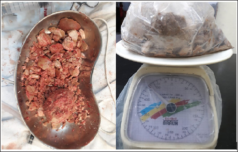 Click here to view Large Figure 1 biomedres-openaccess-journal-bjstr