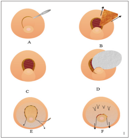 Click here to view Large Figure 5 biomedres-openaccess-journal-bjstr