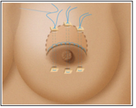Click here to view Large Figure 6 biomedres-openaccess-journal-bjstr