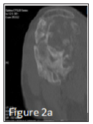 Click here to view Large Figure 7 biomedres-openaccess-journal-bjstr