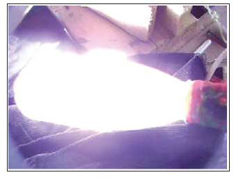 Click here to view Large Figure 2 biomedres-openaccess-journal-bjstr