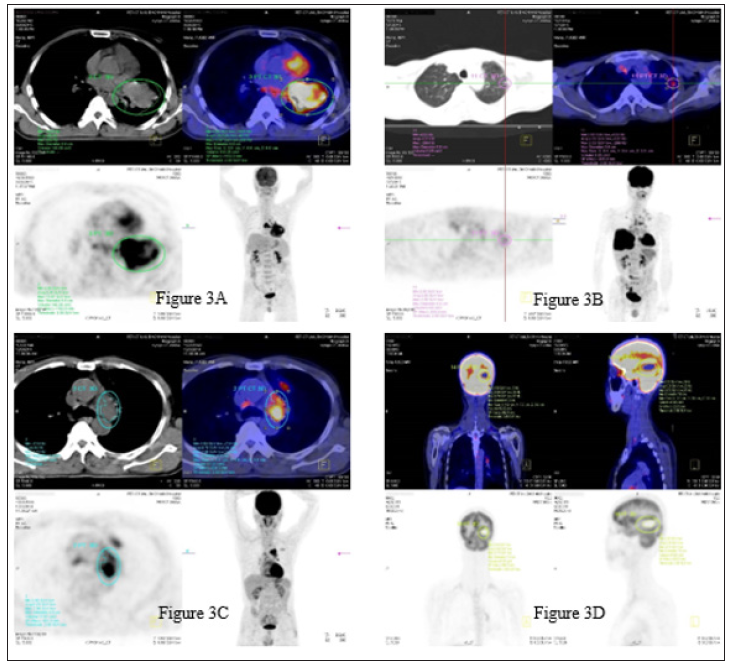 Click here to view Large Figure 3 biomedres-openaccess-journal-bjstr