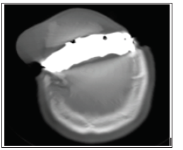 Click here to view Large Figure 1 biomedres-openaccess-journal-bjstr