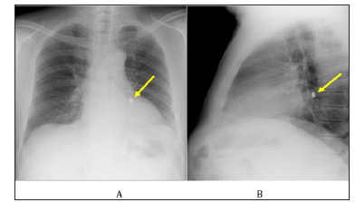 Click here to view Large Figure 1 biomedres-openaccess-journal-bjstr