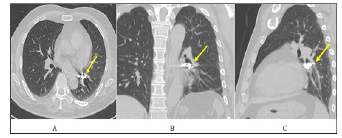 Click here to view Large Figure 2 biomedres-openaccess-journal-bjstr