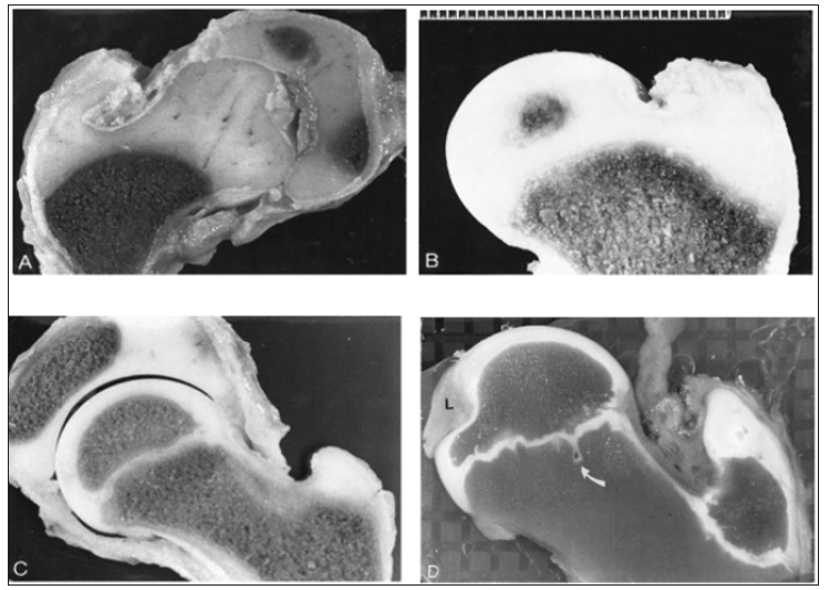 Click here to view Large Figure 1 biomedres-openaccess-journal-bjstr