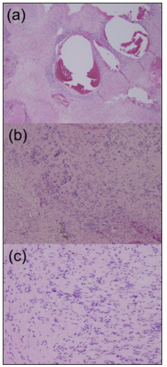 Click here to view Large Figure 2 biomedres-openaccess-journal-bjstr