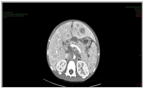 Click here to view Large Figure 1 biomedres-openaccess-journal-bjstr