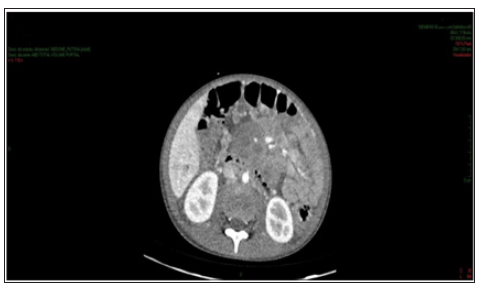 Click here to view Large Figure 2 biomedres-openaccess-journal-bjstr