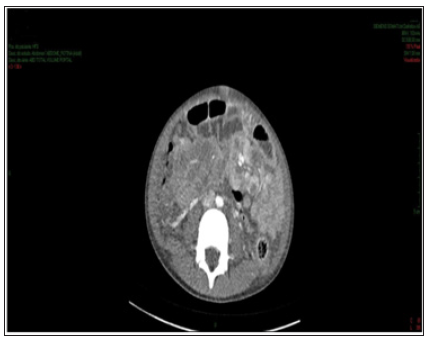 Click here to view Large Figure 3 biomedres-openaccess-journal-bjstr