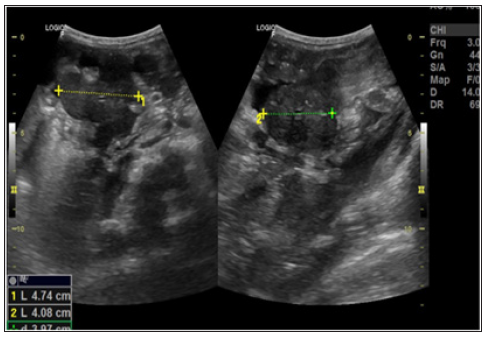Click here to view Large Figure 6 biomedres-openaccess-journal-bjstr