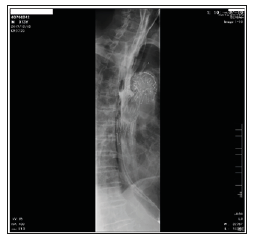 Click here to view Large Figure 2 biomedres-openaccess-journal-bjstr
