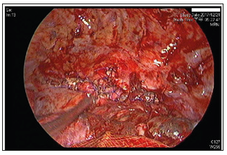 Click here to view Large Figure 4 biomedres-openaccess-journal-bjstr