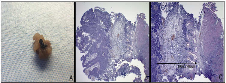 Click here to view Large Figure 1 biomedres-openaccess-journal-bjstr