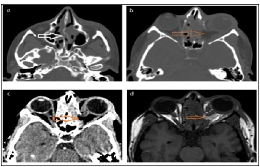Click here to view Large Figure 3 biomedres-openaccess-journal-bjstr