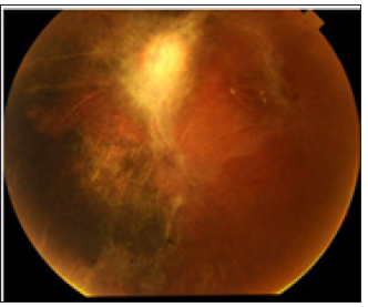 Click here to view Large Figure 4 biomedres-openaccess-journal-bjstr