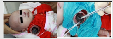 Click here to view Large Figure 2 biomedres-openaccess-journal-bjstr