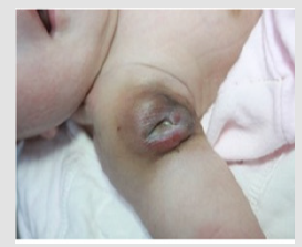 Click here to view Large Figure 3 biomedres-openaccess-journal-bjstr