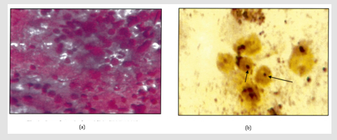 Click here to view Large Figure 4 biomedres-openaccess-journal-bjstr