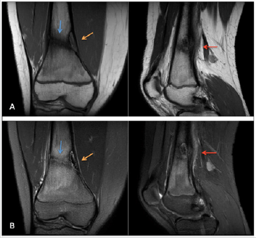 biomedres-openaccess-journal-bjstr