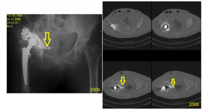 biomedres-openaccess-journal-bjstr