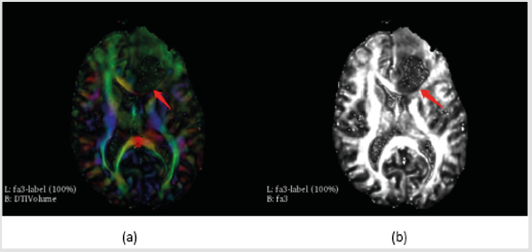 biomedres-openaccess-journal-bjstr