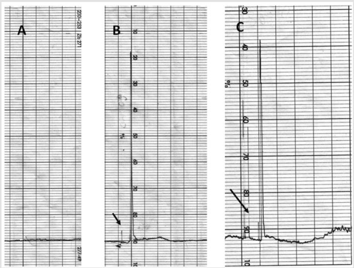 biomedres-openaccess-journal-bjstr