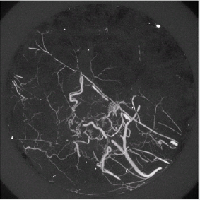 biomedres-openaccess-journal-bjstr