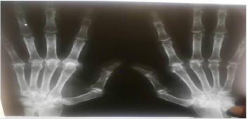 biomedres-openaccess-journal-bjstr