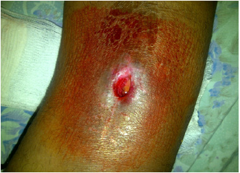 biomedres-openaccess-journal-bjstr